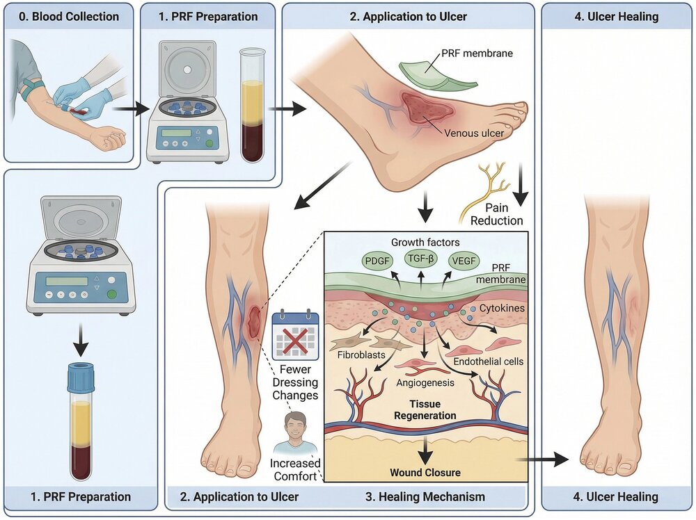 Effect of platelet-rich fibrin gel combined with alginate dressing on healing of active venous leg ulcers: a randomized clinical trial